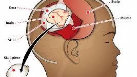 Craniotomy with elevation of bone flap CPT code - simplify medical coding