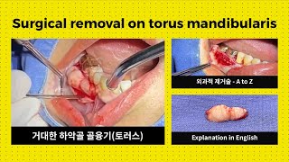 거대한 하악골 골융기(torus) 제거 수술 실황 A to Z