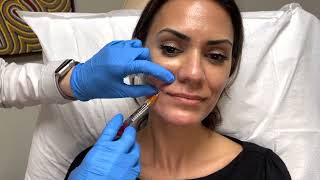 RHA Filler Informational