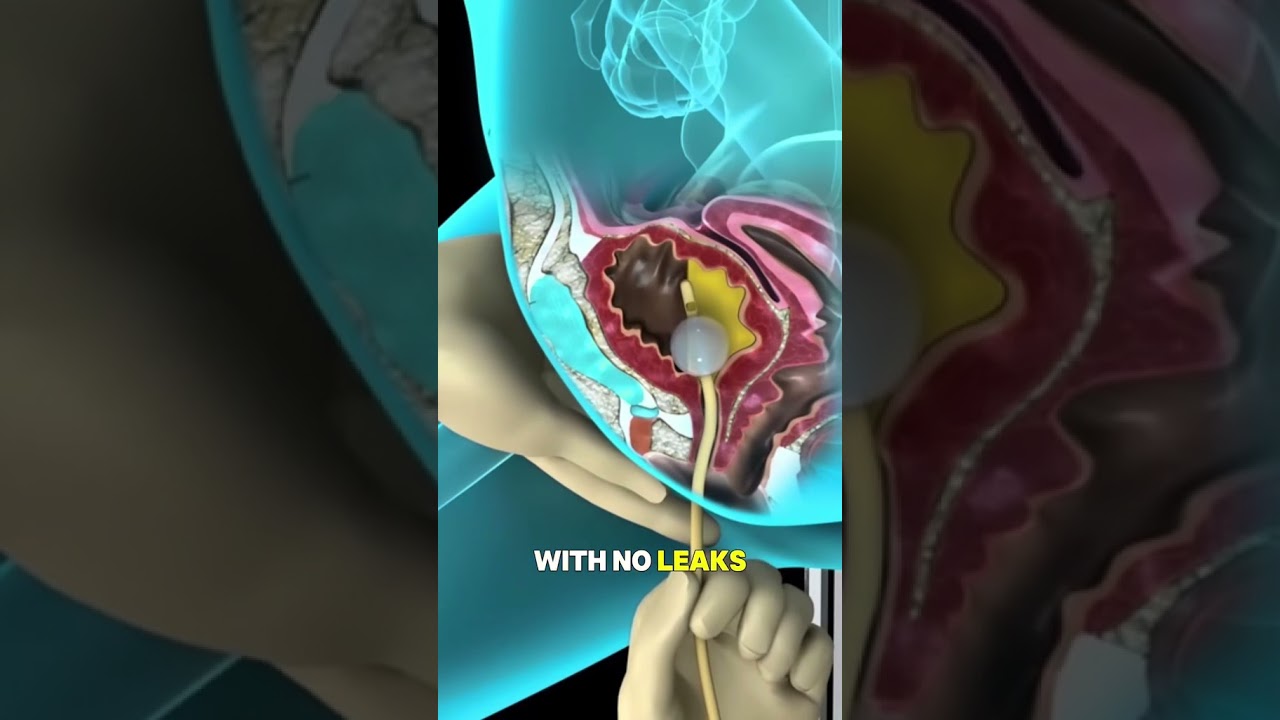 This Tube Saves Lives: How Urinary Catheters Really Work. 