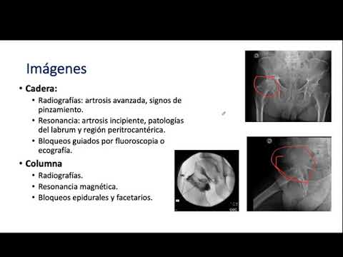 Sindrome cadera columna