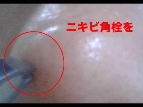 ニキビ 角栓を取ってみた 粉瘤 Youtube
