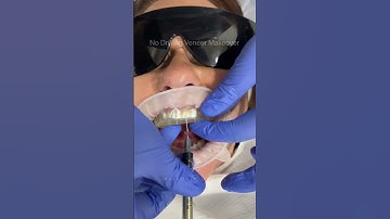 Our no drilling predesigned composite veneer technique for this smile makeover. 8 teeth treated ✨