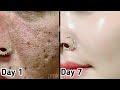 सिर्फ 7 दिनों मे open pores से हमेशा के लिए पाइये छुटकारा, Get rid of large open pores, Black heads