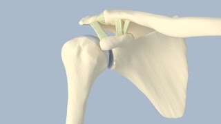 Acromioclavicular Separation Surgery