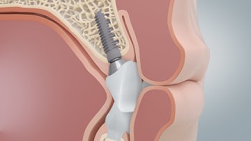 Dental Implants vs Bridges for Missing Teeth (3D-Animation)