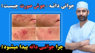 جوانی دانه یا جوش صورت چیست و علت پیدا شدن جوانی دانه چیست  What is face acne & causes of face acne