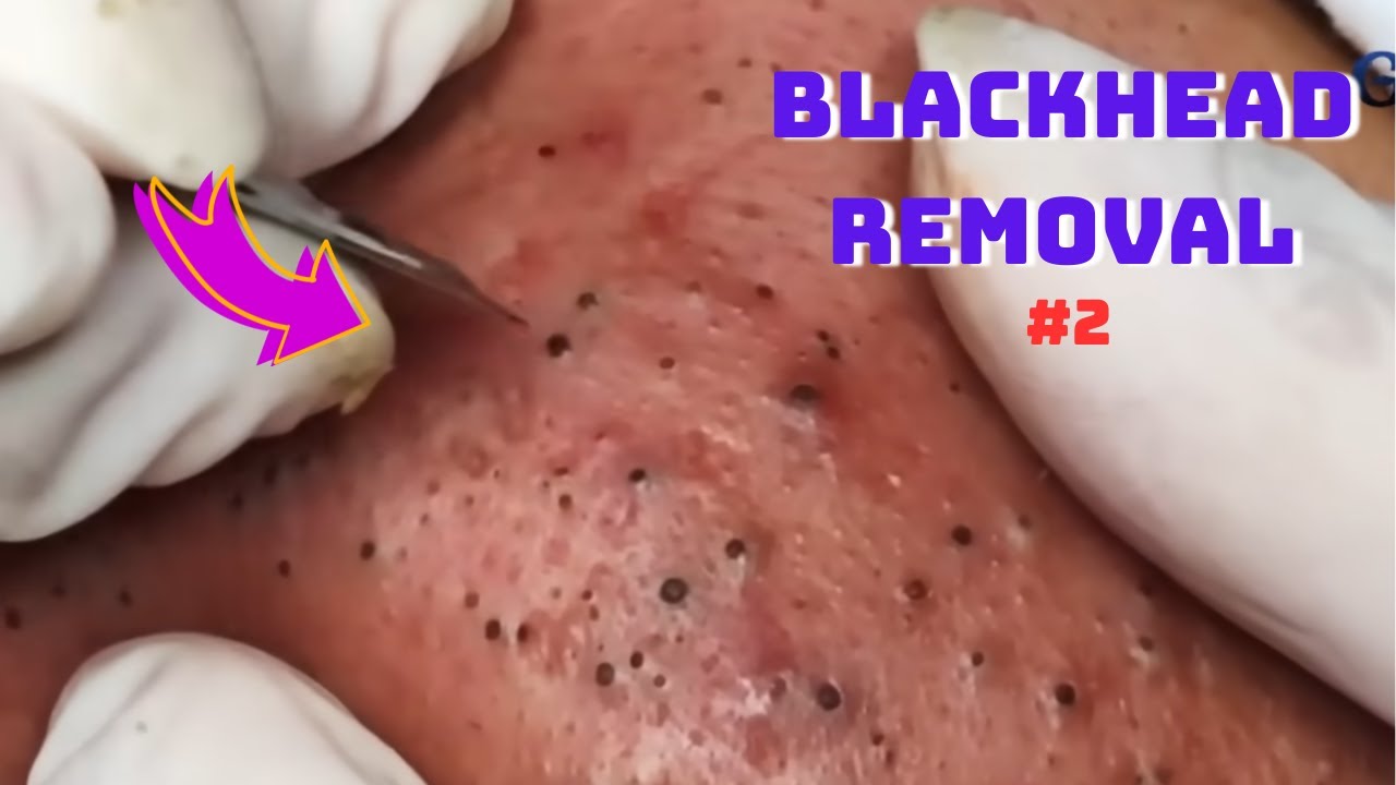 New Pimple Popping Video 2025 Satisfying Blackhead Removal 5 