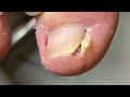 100% Skillful to remove all the build up under nail