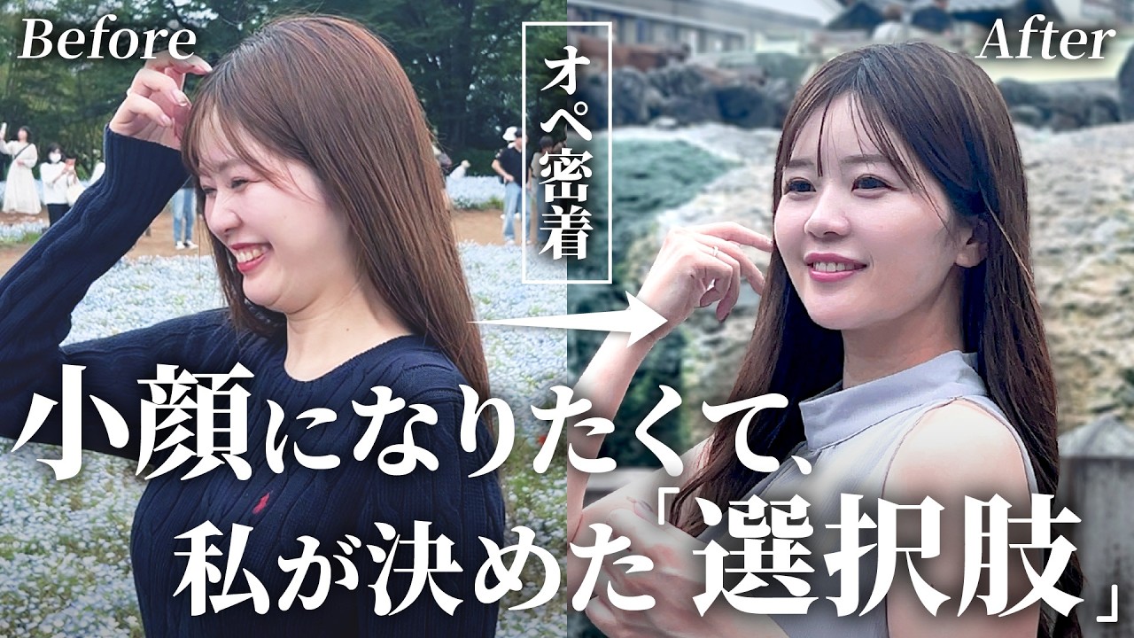 【密着Vlog】美容クリニック受付が信頼している先生に輪郭フル施術を決意した理由とリアル密着