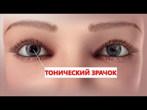 👁👁РАЗНЫЙ ДИАМЕТР ЗРАЧКОВ. АНИЗОКОРИЯ. ТОНИЧЕСКИЙ ЗРАЧОК