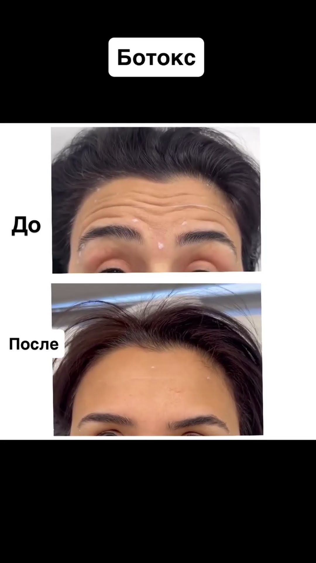 Botoks: əvvəl və sonra