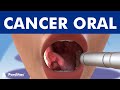 El CÁNCER ORAL - Causas, síntomas y tipos de tumores en la boca ©