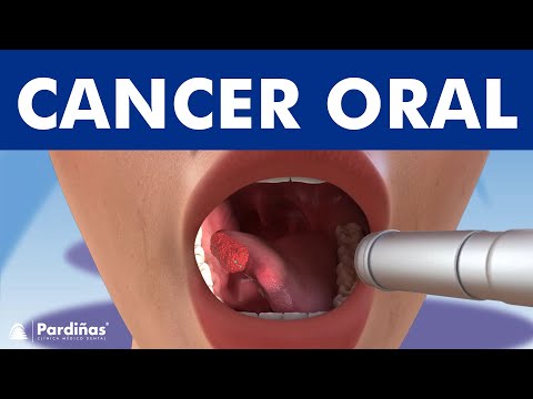 Vídeo: Càncer De Boca (Amelobastoma) En Gats