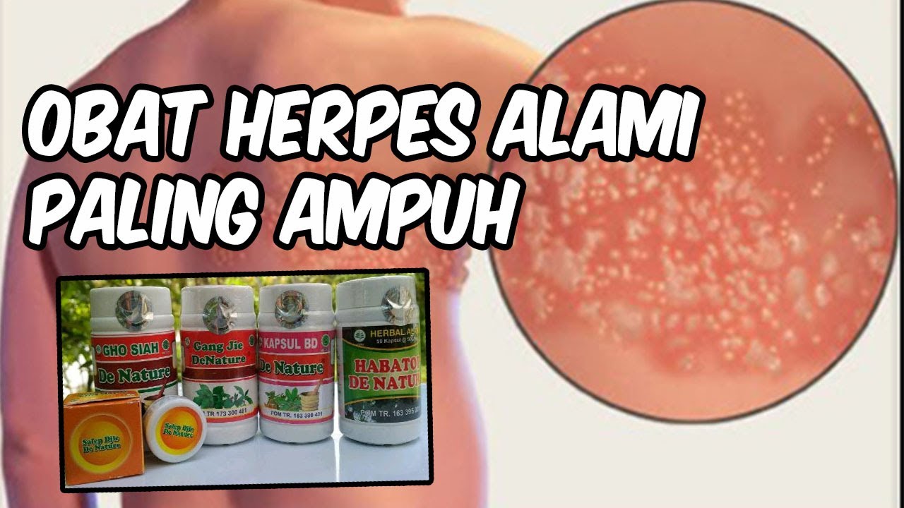 OBAT HERPES PALING AMPUH !!! Cara Mengobati Herpes Secara Cepat Dan