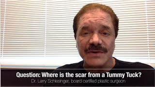 Hawaii Tummy Tuck - Where is the Scar?  Dr. Larry Schlesinger (Abdominoplasty)
