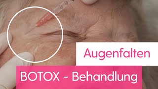 Augenfalten BOTOX - Behandlung (Krähenfüße)