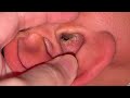 【2024.12.5】耳見た瞬間声出た👂20代男性の耳の中!
