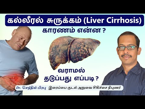 Liver Cirrhosis | Causes & Treatment கல்லீரல் சுருக்கம் காரணம் என்ன ?வராமல் தடுப்பது எப்படி ?