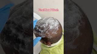 Final Head Wash #hairsurgeon #hairtransplant #hospital #dhi