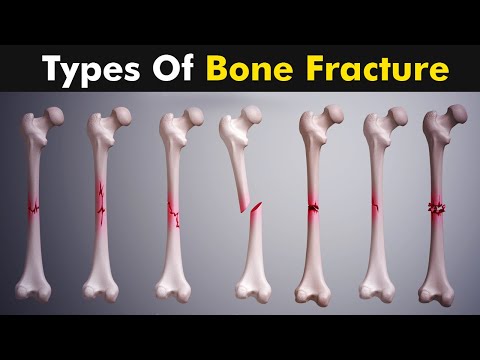 Video: Cum se identifică o fractură (cu imagini)