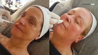 BCN Peel procedure