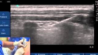 Ultrasound-Guided Paravertebral Block