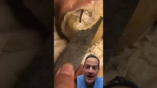 Doctor Reacts: Nail stuck in foot for years shorts