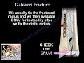 Galeazzi Fracture - Everything You Need To Know - Dr. Nabil Ebraheim