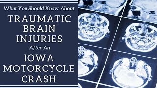 What You Should Know About Traumatic Brain Injuries Caused by a Motorcycle Crash