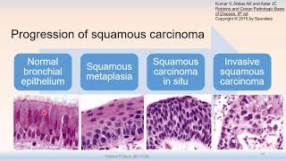 Pathology Scuba - Lung Cancer Histology