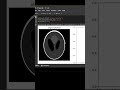 Why Python is Revolutionizing Medical Imaging with Realistic CT Scans