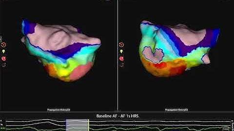 Atrial Fibrillation Mapping with AcQMap®