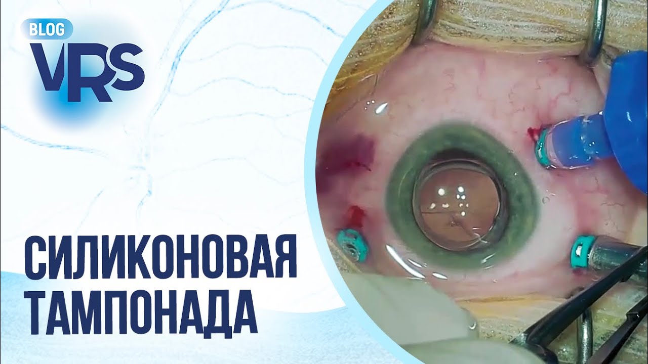 Сахарный диабет / Диабетическая ретинопатия / Тампонада силиконовым ...