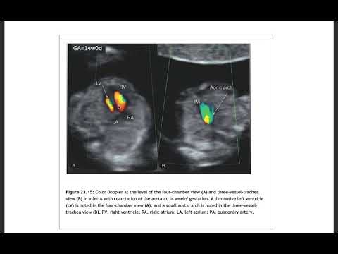 Đọc sách siêu âm tim thai cùng Bác sĩ Võ Tá Sơn: Hẹp eo động mạch chủ - Coarctation of the aorta