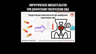 Хирургическое вмешательство при диффузном токсическом зобе #эндокринология #зоб #базедоваболезнь