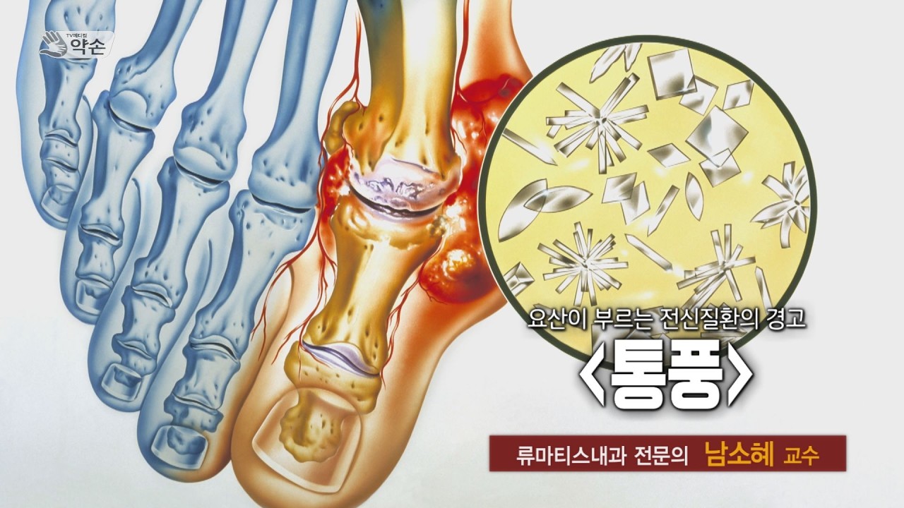 [TV메디컬 약손] 통풍
