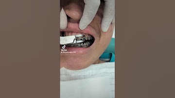 Full tháo niềng răng, tẩy trắng nữa thì tuyệt vời #shorts #niengrang #chỉnhnha