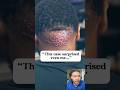 Severe Ingrown Hair Cluster at the Hairline (Viewer Discretion)