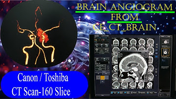 CT Brain Angiogram // From CECT Brain #basicradiology