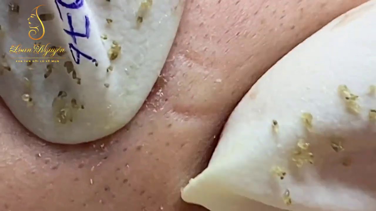 Eliminate a lot of blackheads for female clients (276_ep 3) | Loan Nguyen