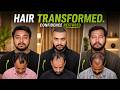 Hair Transplant in Ranchi (HX-ABOD) | Best Results & Cost of Hair Transplant in Ranchi