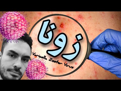 زونا/ابله مرغان/پیشگیری و درمان /بررسی داروساز