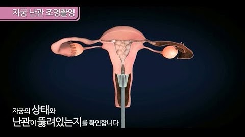 [난임검사]  자궁 난관 조영 촬영 (서울의료원 가임센터) ⓒ한국 머크 #난임치료 #난임센터 #시험관아기 #인공수정 #난임시술 #난임