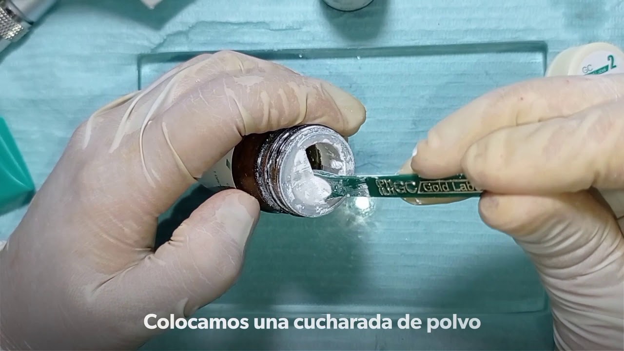 Restauración con ionomero de vidrio en dientes temporales - YouTube