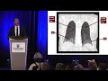 Evaluation and Management of Scleroderma Lung Disease- Aryeh Fischer, M.D.- 2017