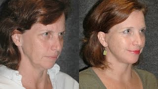Mini Facelift Before and After on 51 Year Old Woman | Dr Andrew Jacono Reviews #mini-facelift