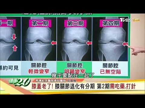 治療退化性關節炎免開刀，PCP 細胞治療重享靈活人生！健康 2.0