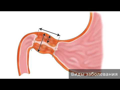 Пилороспазм. Как лечить пилороспазм.