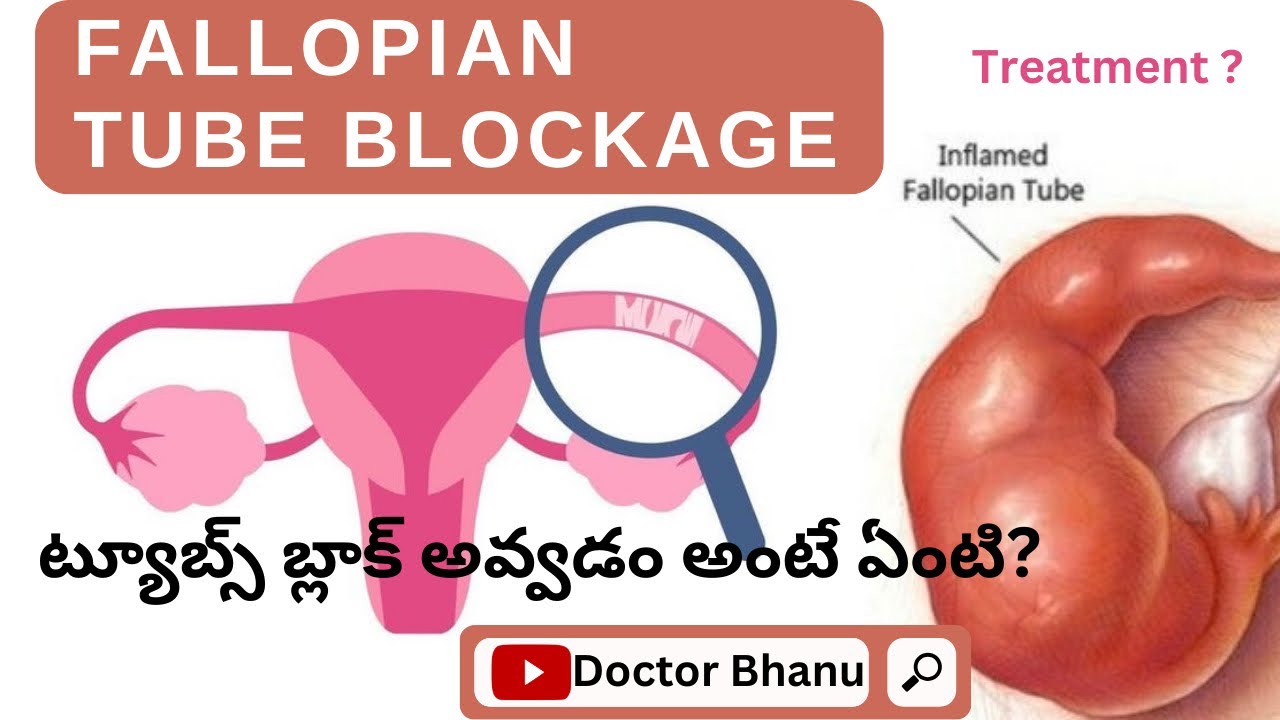 Fallopian Tubal Blockage In Telugu Causes Symptoms Diagnosis Fallopian Tubal Blockage In Telugu Causes Symptoms Diagnosis